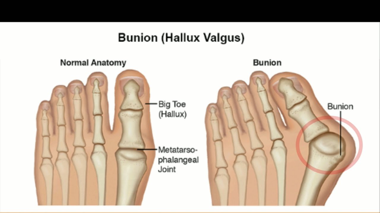 Top 5 Hallux Rigidus Exercises You Should Try Today