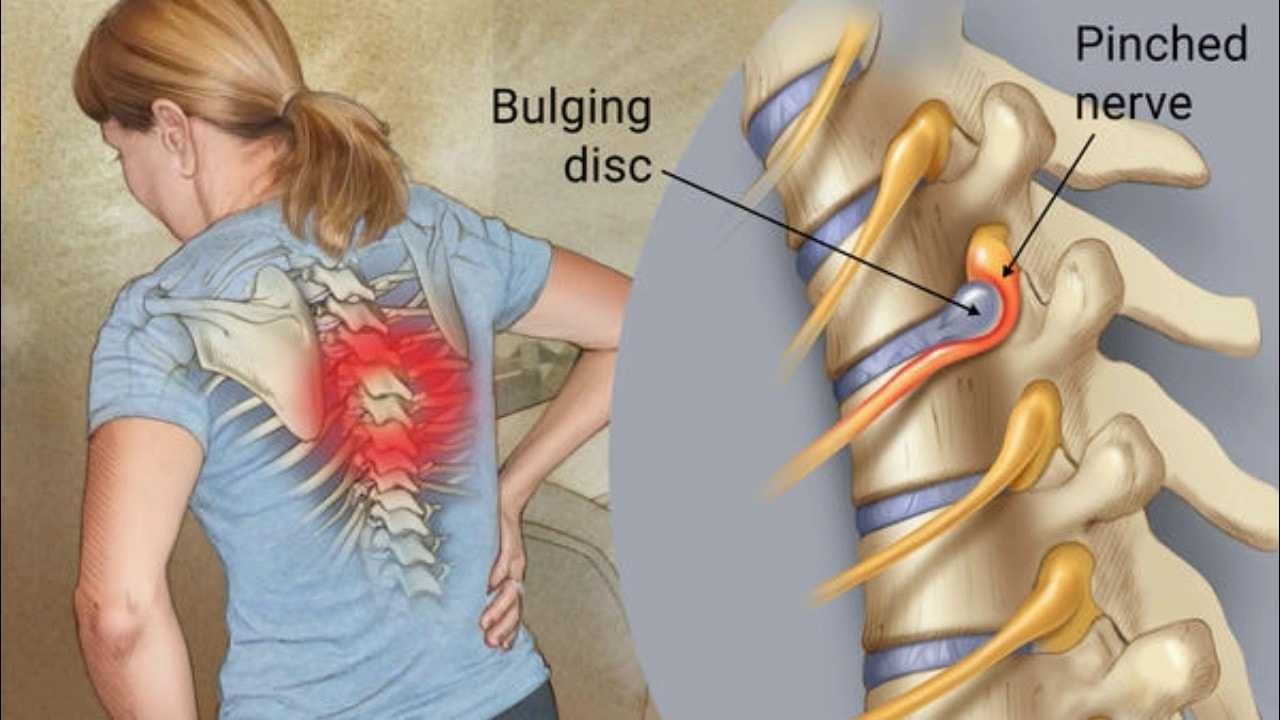 Top Thoracic Outlet Syndrome Exercises for Pain Relief