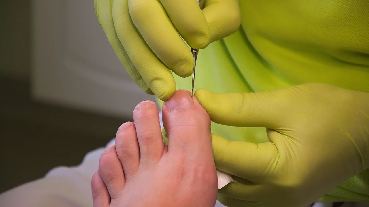 Best Hammer Toe Exercises: Top 10 Solutions for Relief